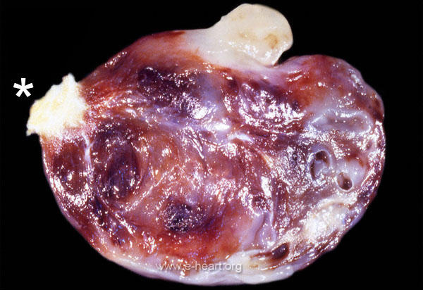 Myxoma Gross